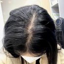 제삼한의원 | 정수리탈모미녹시딜 사용방법 효과 효능 올리는 방법