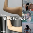 대한바이오피드 | 팔지방흡입 후기 (내돈내산)｜붓기 · 통증 · 회복과정 총정리 (당일 ~ 6개월 까지 변화)