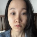 귀족 | 팔자주름리프팅 귀족침 일주일 후기 멍 붓기 적어서 좋아요!