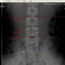 L-spine x-ray 분석....랜드마크 관련. 이미지