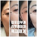 미소가인피부과의원 | 김포 피부과 리팟레이저 후기 흑자제거2탄