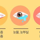한쪽 눈충혈 원인, 눈병 각막염 증상 (안구 통증, 오른쪽 왼쪽 눈통증) 이미지