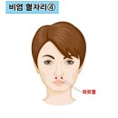 붙이는침으로 비염을 극복하는 여시의 글 ( 삭제하였다 재업로드 합니다) 이미지