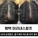 (주)미리내 | 평택 정수리 탈모관리 후기ㅣ20대 남성, 미리내스칼프에서이렇게 달라졌어요!