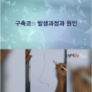 코 성형 후 구축이 생기는 과정 이미지