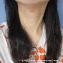 차엔 | 양산피부과 인모드후기 3주차 느낀 솔직 후기