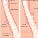 급성횡단성척수염 원인과 증상은 무엇 이미지