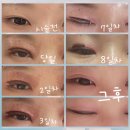 대구 플라즈마 눈매교정 페이스리프팅 _ 플라즈마쌍꺼풀 아미뷰티 리얼 후기
