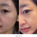 강남-135 | 의정부 피부과 리쥬란힐러 nctf135 스킨보톡스 내돈내산 솔직 후기