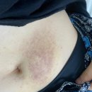 괄사마사지로 림프순환 독소제거 후기 동심기테라피 이현숙챠밍클럽