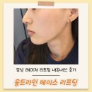 예쁨주의쁨의원 | 예쁨주의쁨의원 레이저 리프팅 울트라인 페이스 내돈내산 후기(효과,통증)