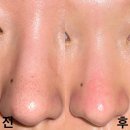라파 피부마사지 | 호평동 피부관리 잘하는 라파에스데틱 코 블랙헤드 관리 후기 : 네일아트 남양주 왁싱 마사지