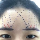 한스클리닉의원 | 이마실리프팅 비용, 후기 - 눈두덩이가 내려와서 속쌍꺼풀이 된 환자분의 이야기