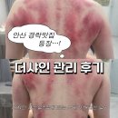 샤인 | 안산 예신 관리 끝판왕 경락맛집 더샤인 내돈내산 후기(feat.17회차) 멍 사진 주의