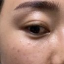 대전둔산동피부과 스킨보톡스후기(제오민 내돈내산)