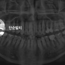 사랑니 발치에도 종류가 있다 (단순발치, 난발치, 매복 발치)