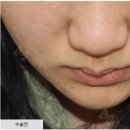 콧볼축소 후기 - 수술 방식을 다르게 적용해야 합니다.