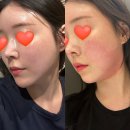 [강남피부과] 강남역인모드 솔직 후기! 이중턱 조지고 온날