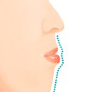 미소드림 | 비수술주걱턱교정비용 후기 미소드림치과의원에서!