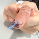 예손병원 | ③부천 예손병원 입원 후기, 1일차~퇴원까지, MRSA 이슈로 입원 연장