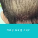 향염채단 | [5개월 아기] 지루성두피염 투병기(라고 하면 너무 심각해 보이나..?)