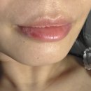 미래성형외과의원 | [벤스의원 수지점] 보톡스+입술필러 맞으러 감! 가격정보와 후기