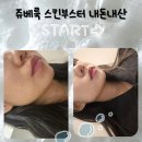 홍대피부과 쥬베룩 스킨부스터 손주사 후기