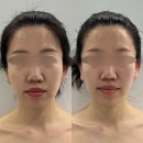 아벨라 에스테틱 | 얼굴선이 슬림하게! 대전 윤곽관리 아벨라뷰티 후기