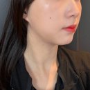 국제의원 | 올타이트리프팅 400샷만에 턱선 하프한 효과 본 신사 피부 클리닉 의원 후기