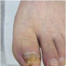 베어네일(Bear nail) | 진주 시내 내성발톱 10년 묵은 고민 드디어 끝낸 곳 후네일&amp;베어진주장대점