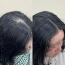 지오플러스 | 인천 인하대역 혜지오스튜디오 두피페인팅 4회 후기 산후탈모 헤어라인 정수리 커버 통증