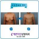 FTM 유방절제술]많이 처진 가슴-전후 사진 이미지