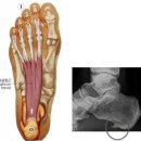 족저근막염 [Plantar Fasciitis]이란? (펌) 이미지
