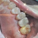 랭스치과의원 | 오스템BA 임플란트 전문 20년 한국을 빛낸 우수치과 서초구 신사역 랭스치과.50대 어금니임플란트 후기