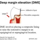 벤처세라믹치과기공소 | 찬물 닿으면 시려요. 옛날에 때운게 구멍이 있는데 그것 때문에 그런가요? 부천 치과 세라믹 오버레이.