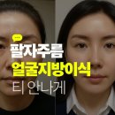 자연미한뱡병원 | 팔자주름 얼굴지방이식 자연미 있게 채우려면
