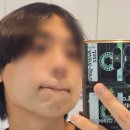 남성시대 | 강남피부과 젠틀맥스프로플러스 남성 수염 3회차제모 내돈내산 후기