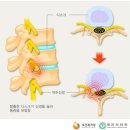 교통사고로 추간판탈출증 후유장해가 발생한 경우 2012년 3월에 가입한 3%이상 상해후유장해담보에 대해 기여도를 적용해야 합니까? 이미지