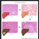 지방간대상질병관리지원비보장 특별약관[무배당 메리츠 속편한 소화계질환보장보험2210(1종)] 이미지