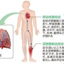 「다리의 혈전」죽음에 이르는 일도。비행기탑승보다 많은 것은 이미지