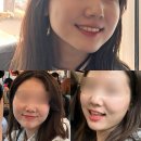 신논현역 피부과 조은날클리닉 인모드 리프팅 후기(fx, 포마, 멍)