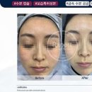 림프랩 네이버블로그