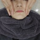 서울 강남 피부과 온다리프팅 후기 온다효과