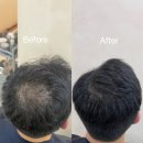 남자 정수리 탈모 가리기 끝판왕 💇‍♂️ 두피페인팅 1회 시술로 자신감 회복 | 홍대미용실 아르투 헤어