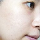 얼굴잡티 피부과모공관리 두 마리 토끼 잡는 어펌레이저 &amp; 네오빔 후기