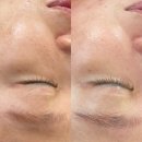 부산 여드름흉터 모공 해결 아르에스테틱 후기