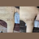 팔 좁쌀여드름 팔드름 없애는법 김포 피부관리실 썸굿