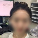 [3탄] 3500모 절개 모발이식 6개월 후기 (엠자이마탈출~!~!)