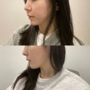 오아시스개발 | 신사역성형외과 스킨부스터 오아시스부스터 주사 리얼 후기
