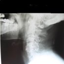 경추뼈 변형 X-ray 이미지